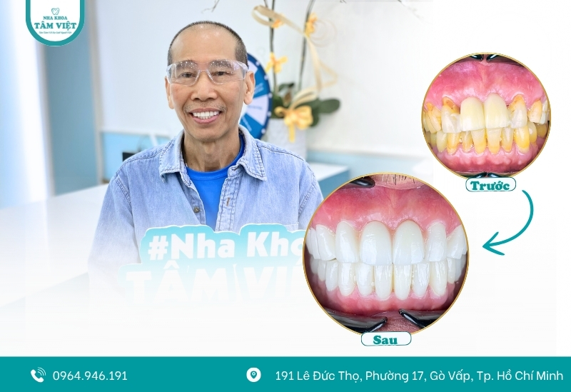 Bọc răng sứ bao lâu hết ê buốt hẳn? 3 Bọc răng sứ bao lâu hết ê buốt hẳn?