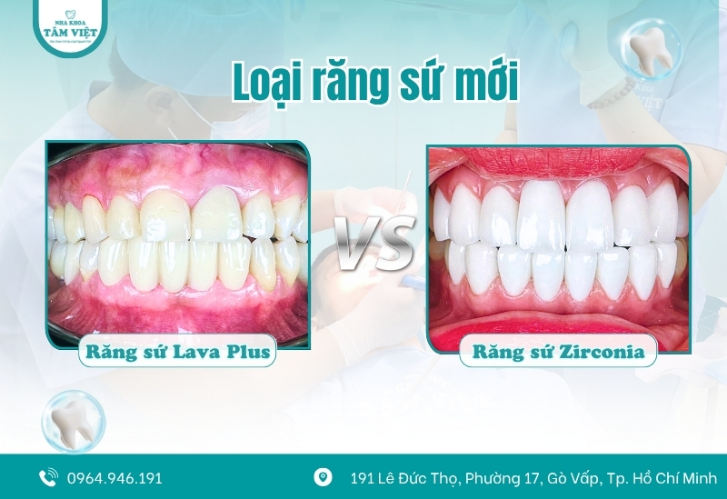 Bọc răng sứ bị sâu giá bao nhiêu tại nha khoa? Có đắt không? 4 Loại răng sứ mới