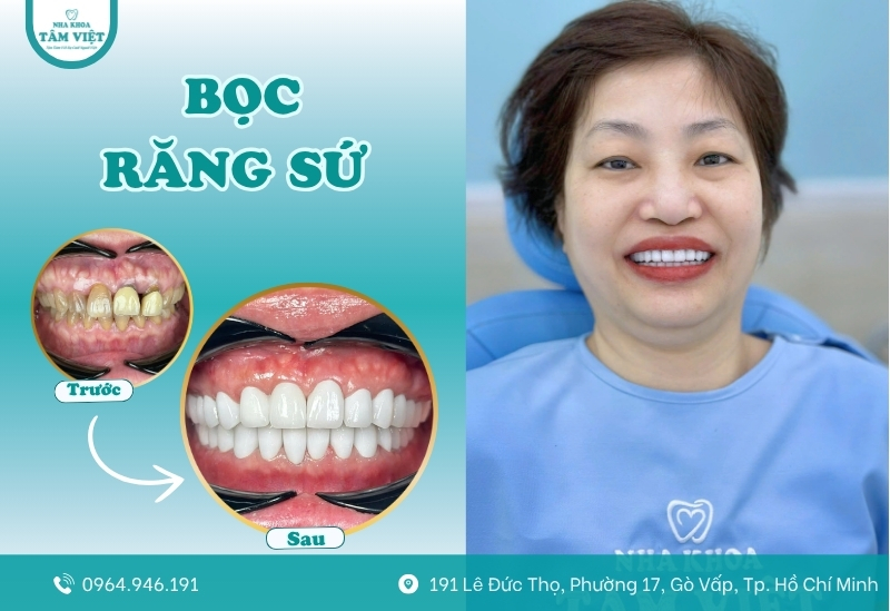 Bọc răng sứ bị sâu giá bao nhiêu tại nha khoa? Có đắt không? 5 Bọc răng sứ tại Nha khoa Tâm Việt