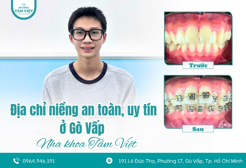 Địa chỉ niềng răng an toàn sau bọc sứ