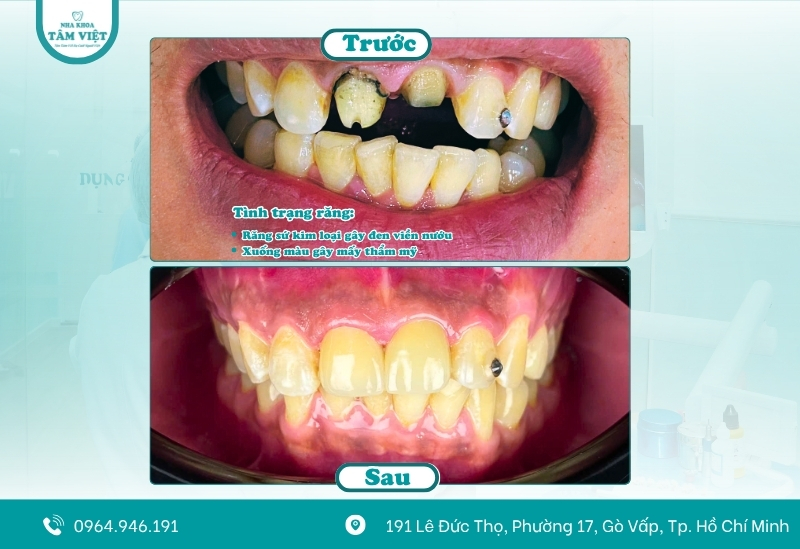 Bọc răng sứ lần 2 khi nào? Thực hiện ra sao? 2 Răng sứ bị đen viền nướu
