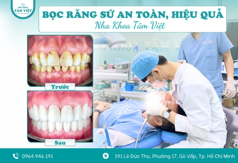 Bọc răng sứ lần 2 khi nào? Thực hiện ra sao? 5 Quy trình bọc răng sứ lần 2 an toàn và hiệu quả