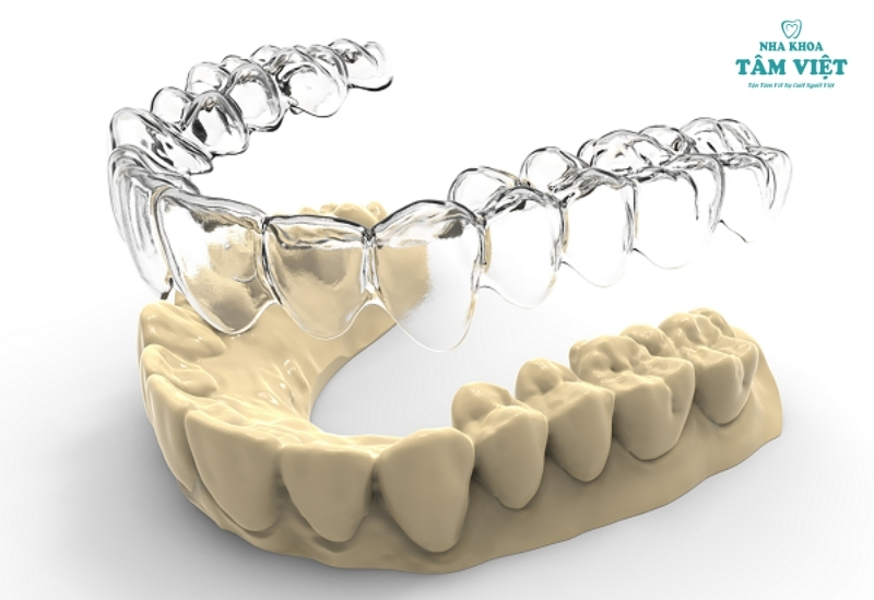 Cập nhật chi phí niềng răng Invisalign tại nha khoa hiện nay 2 Công nghệ niềng răng Invisalign