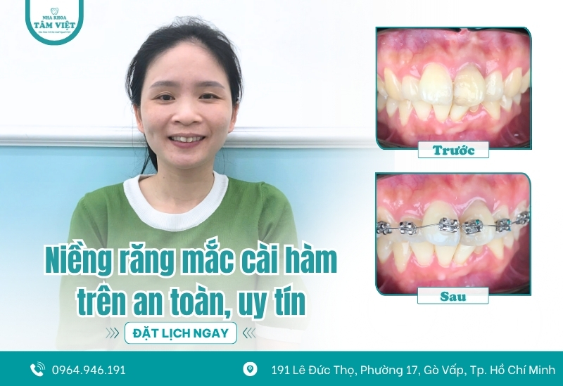 Địa chỉ chỉnh nha gần đây trả góp HCM có bảo hành 2 Xu hướng lựa chọn dịch vụ chỉnh nha trả góp hiện nay