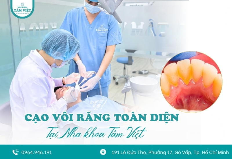 Bí quyết giữ răng trắng khi niềng răng có thể bạn chưa biết 5 Cạo vôi răng định kỳ