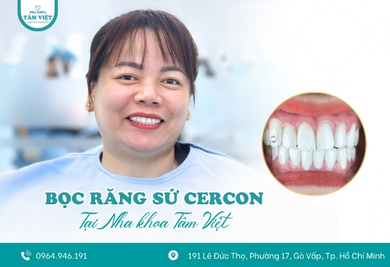 Địa chỉ nha khoa bọc sứ Gò Vấp uy tín, đáng tin cậy 4 Bọc răng sứ Cercon tại Tâm Việt