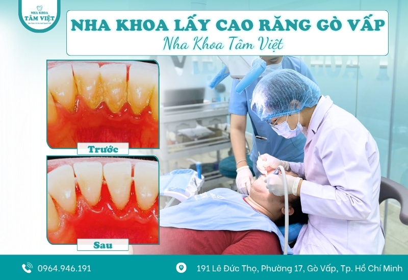 Nha khoa lấy cao răng Gò Vấp nào uy tín, an toàn, hiệu quả?