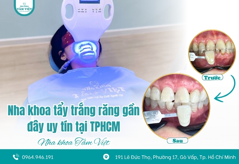 Tìm nha khoa tẩy trắng răng gần đây uy tín tại TPHCM