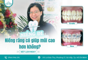 Liệu niềng răng có giúp mũi cao hơn không?