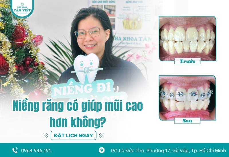 Liệu niềng răng có giúp mũi cao hơn không?