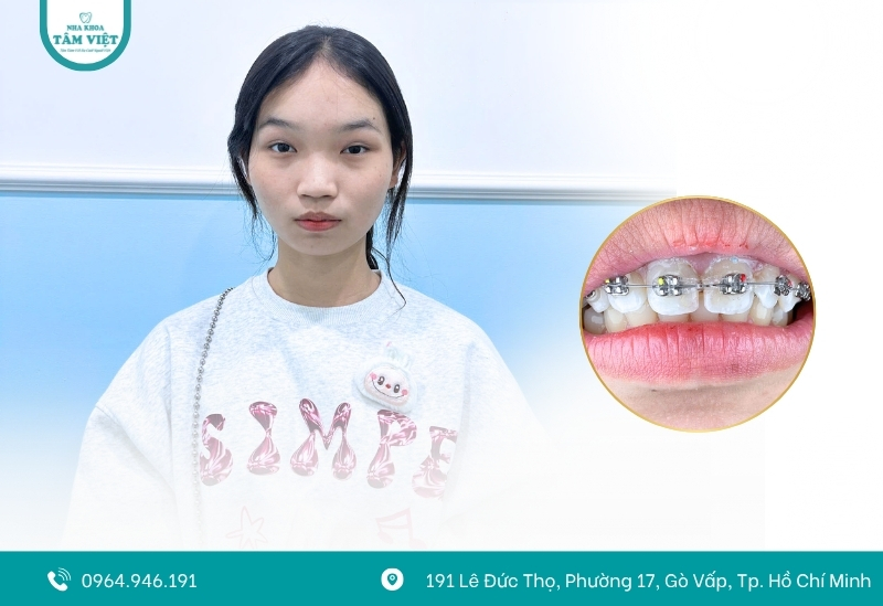 Liệu niềng răng có giúp mũi cao hơn không? 3 Niềng răng tác động đến cấu trúc nào trên khuôn mặt?