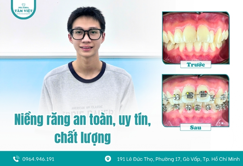 Liệu niềng răng có giúp mũi cao hơn không? 4 Niềng răng có giúp mũi cao hơn không?