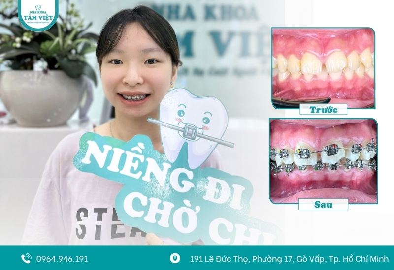 Có nên niềng răng mắc cài cho răng khểnh? 2 Răng khểnh có nên niềng không?