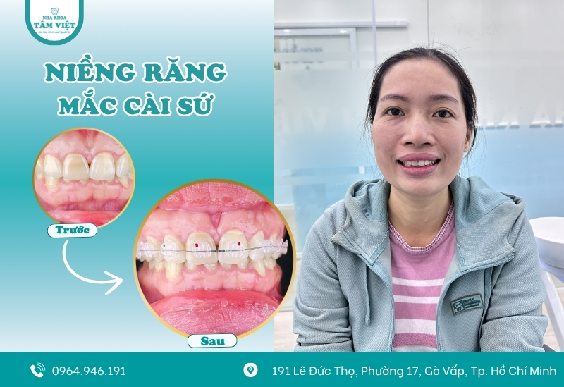 Có nên niềng răng mắc cài cho răng khểnh? 5 Nha khoa Tâm Việt - Giải pháp cho dịch vụ niềng răng chất lượng, giá tốt tại Gò Vấp