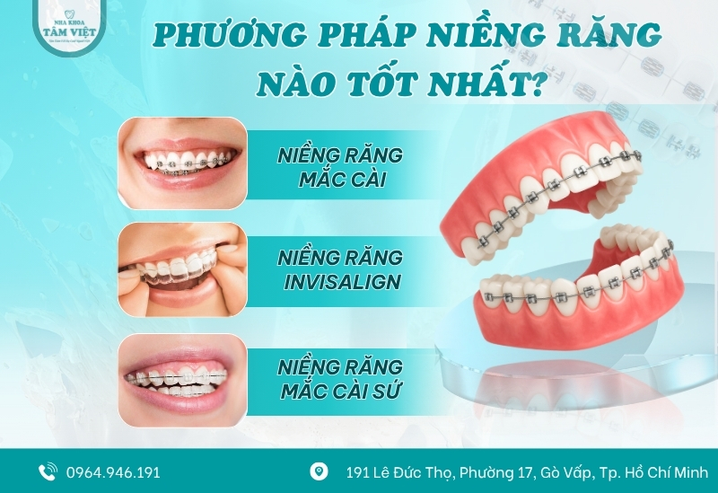 Có nên niềng răng mắc cài cho răng khểnh? 3 Niềng răng mắc cài cho răng khểnh nào tốt nhất?
