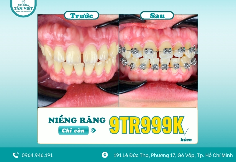 Có giải pháp nào tiết kiệm hơn niềng răng invisalign không?