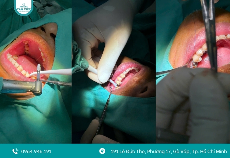 Phòng khám trồng răng implant không đau, an toàn tuyệt đối 4 Quy trình trồng răng Implant không đau, an toàn