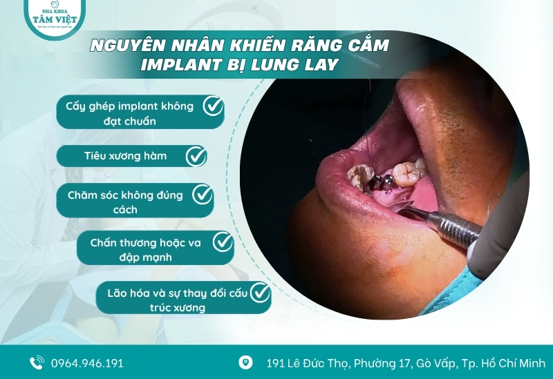 Răng cắm implant bị lung lay, phải làm gì? 2 Nguyên nhân khiến răng cắm implant bị lung lay
