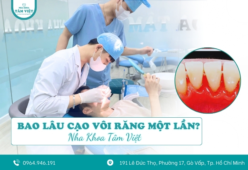 Bao lâu cạo vôi răng 1 lần là tốt nhất?
