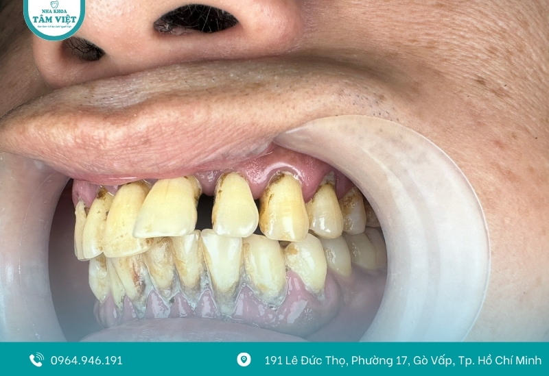 Bao lâu cạo vôi răng 1 lần là tốt nhất? 3 Người hút thuốc, uống cà phê hình thành cao răng nhanh