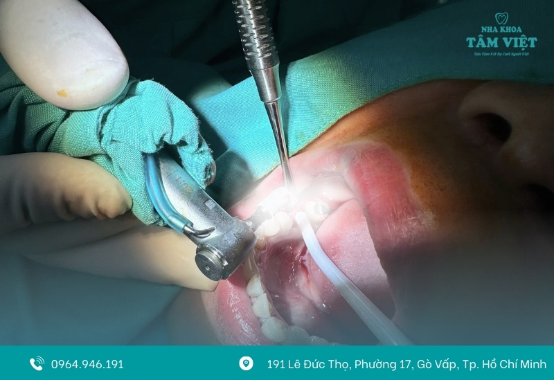 Cấy ghép Implant nha khoa uy tín, giá tốt tại Gò Vấp 2 Có nên chọn cấy ghép Implant không?