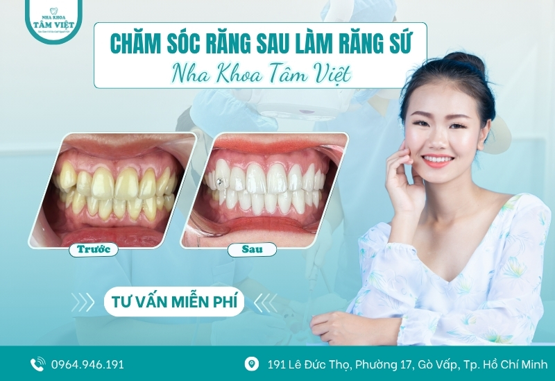 Hướng dẫn chăm sóc răng sau làm răng sứ đúng chuẩn