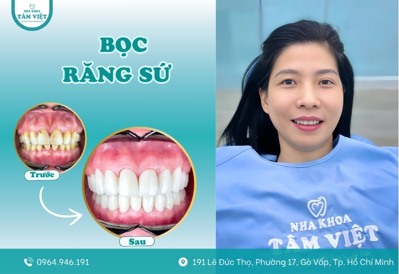 Hướng dẫn chăm sóc răng sau làm răng sứ đúng chuẩn 6 Khách hàng bọc răng sứ tại Tâm Việt