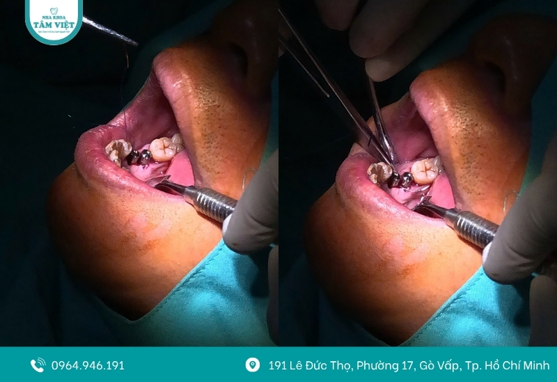 Chăm sóc sau khi cấy ghép Implant đúng cách và an toàn 2 Chăm sóc sau khi cấy ghép Implant trong 48 giờ đầu