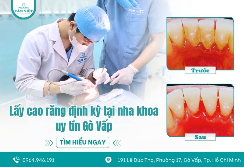 Có nên lấy cao răng thường xuyên không? Bao lâu lấy 1 lần? 4 Bao lâu nên lấy cao răng một lần là tốt nhất?