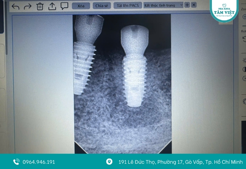 Đâu là nha khoa Implant Gò Vấp giá rẻ, chất lượng? 5 Vật liệu trụ chất lượng