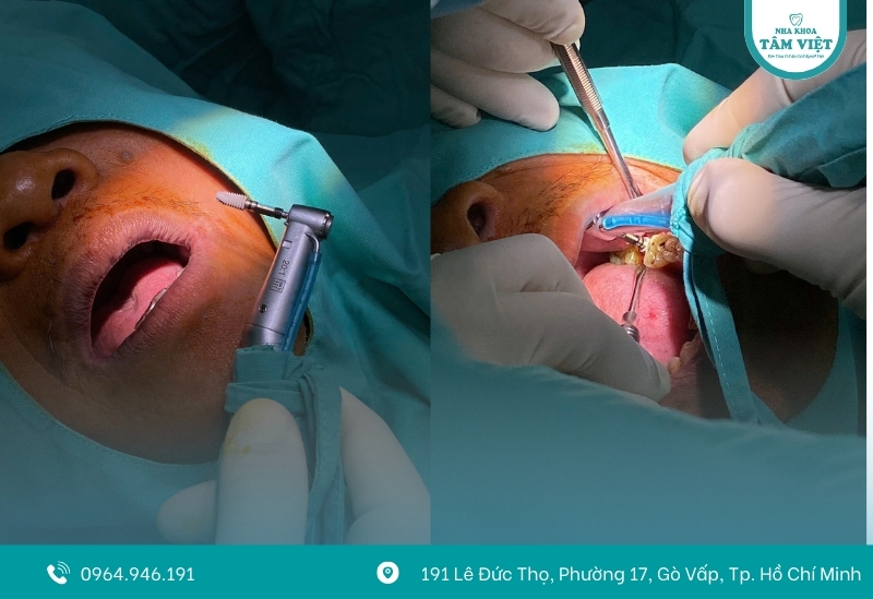 Đâu là nha khoa Implant Gò Vấp giá rẻ, chất lượng? 2 Giá cấy ghép Implant hiện nay bao nhiêu?