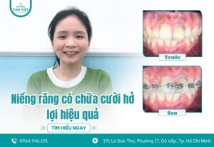 Niềng răng có chữa cười hở lợi hiệu quả không?