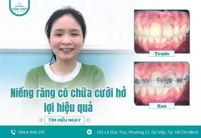 Niềng răng có chữa cười hở lợi hiệu quả không?