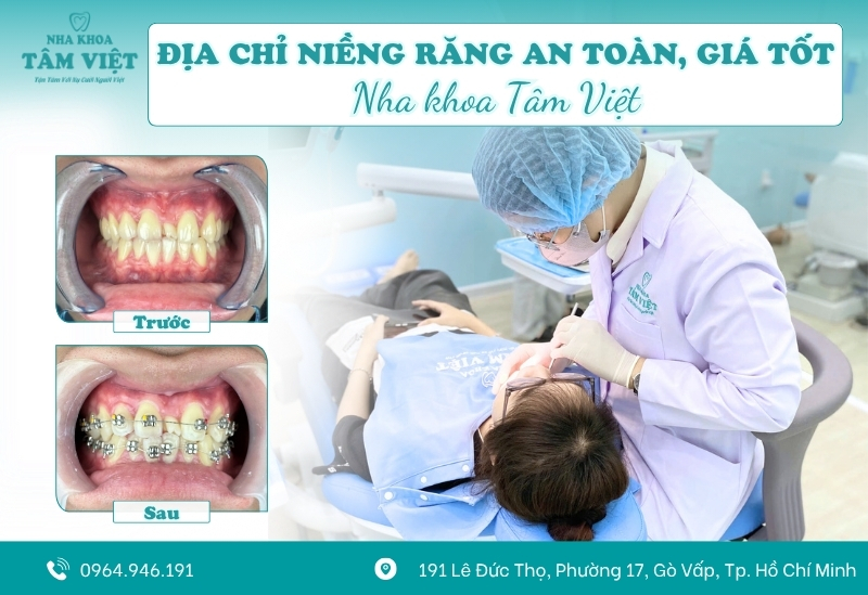 Răng bị lệch sau khi niềng: Nguyên nhân và cách khắc phục 6 Niềng răng an toàn, giá tốt tại Nha khoa Tâm Việt