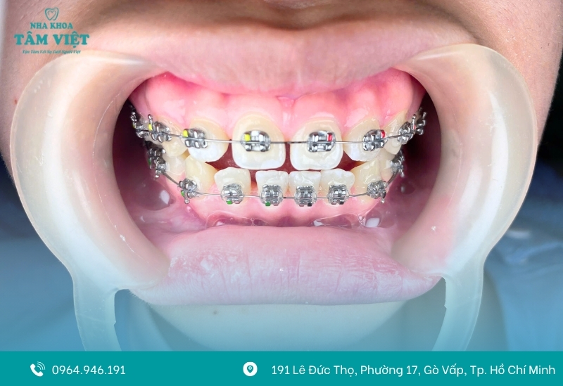 Răng bị lệch sau khi niềng: Nguyên nhân và cách khắc phục 4 Răng bị lệch sau khi niềng có nguy hiểm không?