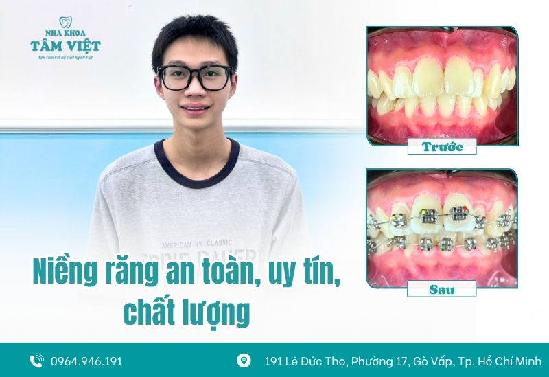 Răng bị lệch sau khi niềng: Nguyên nhân và cách khắc phục 7 Niềng răng an toàn, uy tín, chất lượng tại nha khoa