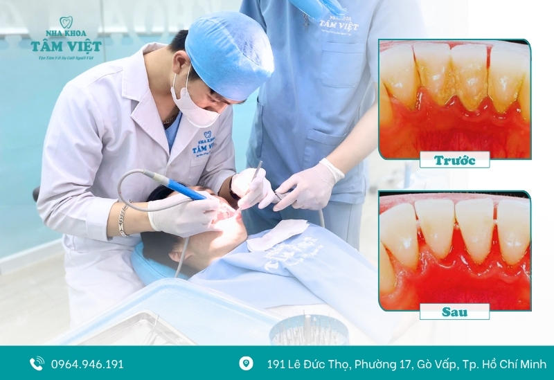 Răng implant có bị sâu không? Lưu ý khi trồng implant 5 Lấy vôi răng định kỳ tại nha khoa
