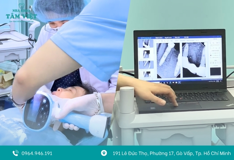 Răng implant có bị sâu không? Lưu ý khi trồng implant 3 Nguyên nhân gây viêm quanh implant