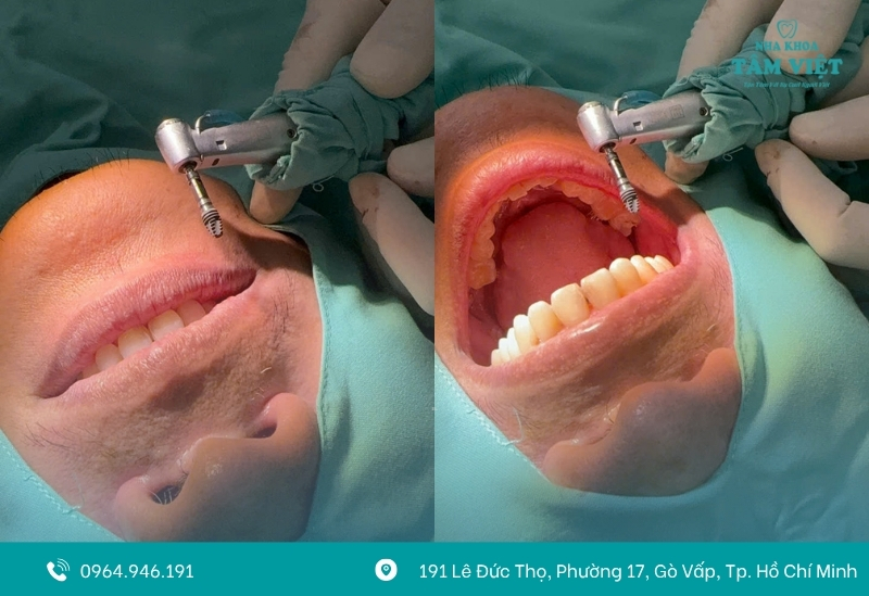 Răng implant có bị sâu không? Lưu ý khi trồng implant 2 Răng implant có bị sâu không?