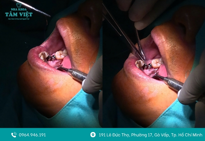 Răng implant có bị sâu không? Lưu ý khi trồng implant 4 Dấu hiệu cần lưu ý khi trồng răng implant