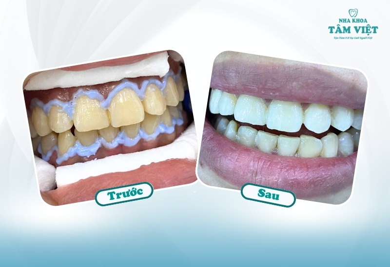 Tẩy trắng răng có làm răng yếu đi không?