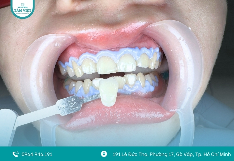 Những đối tượng cần cẩn trọng khi tẩy trắng răng
