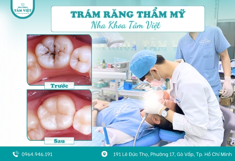 Trám răng thẩm mỹ có đau không và mất bao lâu? 2 Trám răng thẩm mỹ có đau không?