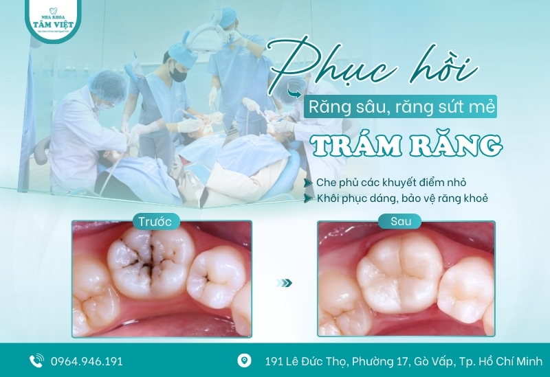 Địa chỉ trám răng uy tín ở Gò Vấp được đánh giá cao 4 Lựa chọn trám răng chuẩn Y khoa tại Tâm Việt