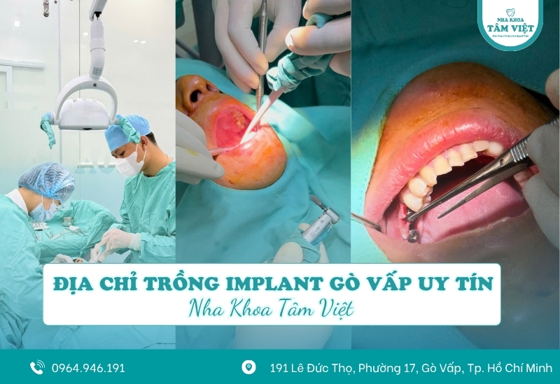 Trồng răng không có chân răng được không? Cách thực hiện 6 Địa chỉ trồng răng implant uy tín tại Gò Vấp