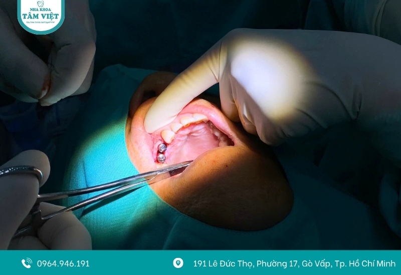 Trồng răng không có chân răng được không? Cách thực hiện 2 Trồng răng không có chân răng bằng phương pháp cấy ghép Implant