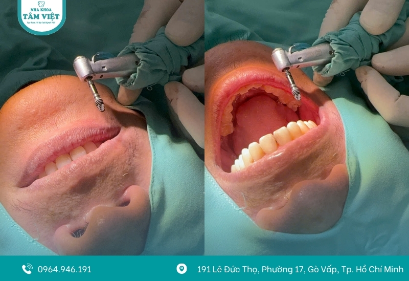 Trồng răng không có chân răng được không? Cách thực hiện 5 Cấy ghép Implant toàn hàm bằng công nghệ All-on-4 hoặc All-on-6
