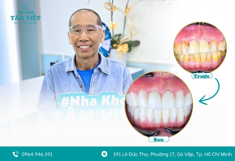 Bọc răng sứ bị viêm lợi: Nguyên nhân và giải pháp 2 Bọc răng sứ bị viêm lợi là gì?