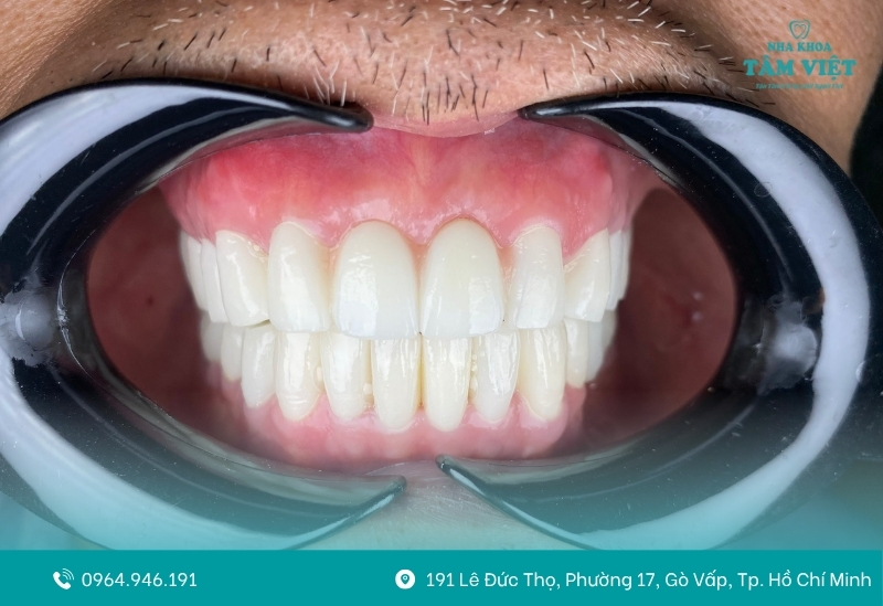 Bọc răng sứ bị viêm lợi: Nguyên nhân và giải pháp 4 Chất liệu mão sứ ảnh hưởng lớn đến sức khỏe mô nướu