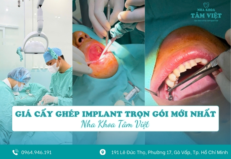 Giá cấy ghép implant trọn gói mới nhất tại TPHCM